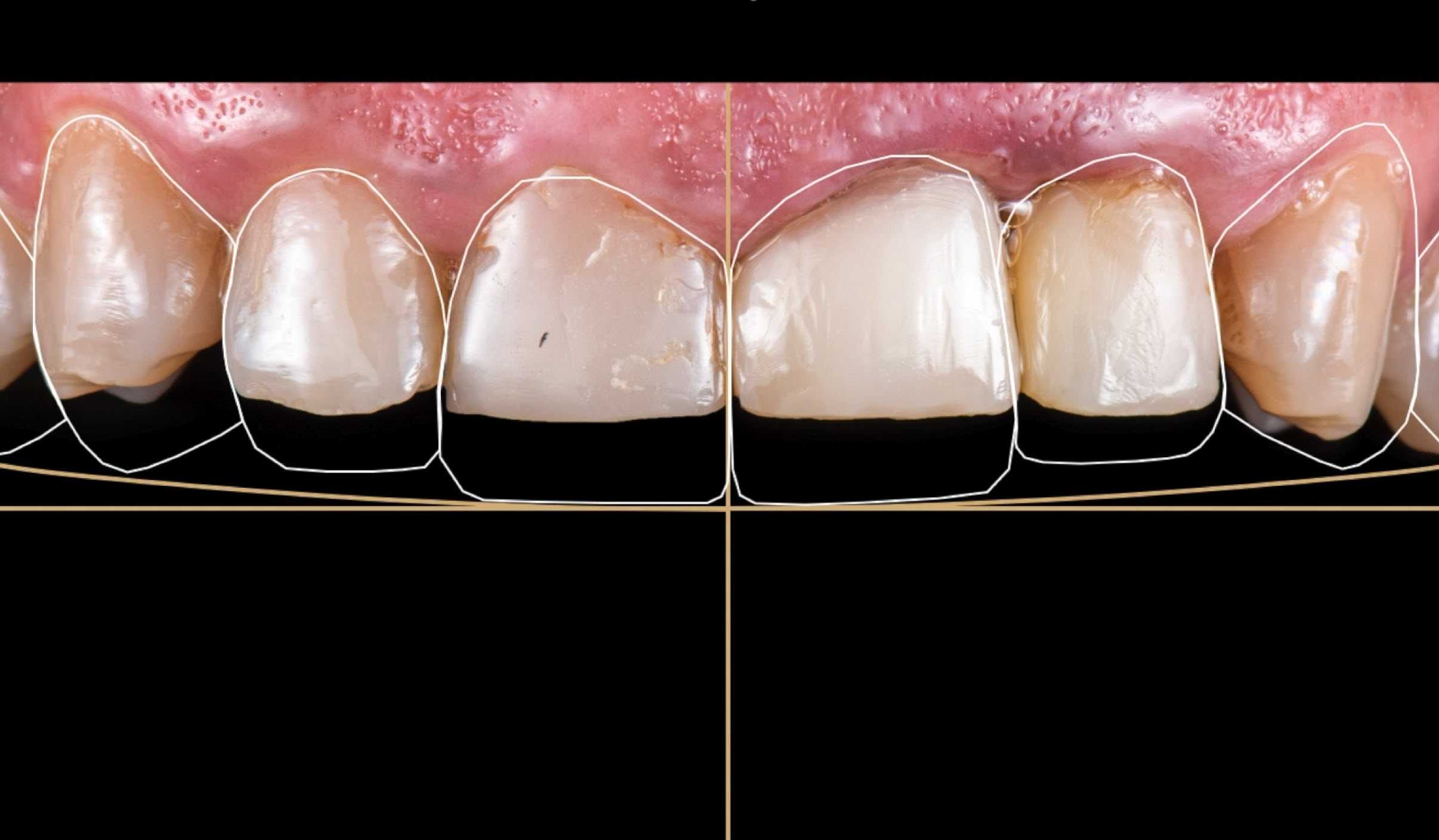 2D Digital Smile Design